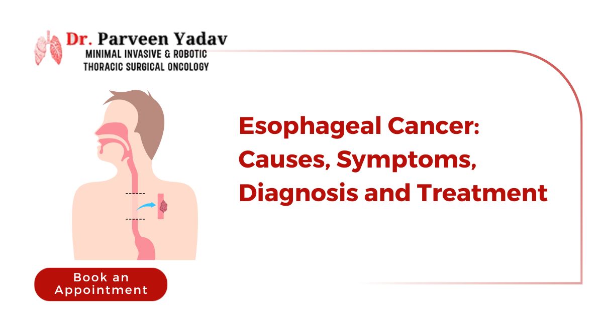 Esophageal Cancer: Causes, Symptoms, Diagnosis, and Treatment