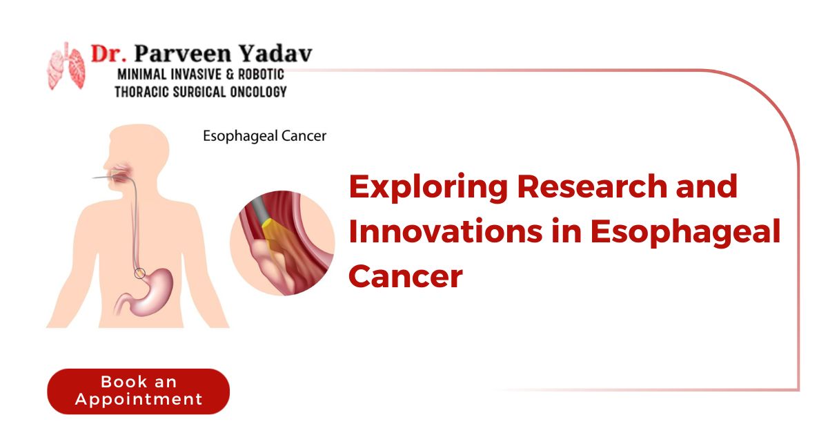 Exploring Research and Innovations in Esophageal Cancer