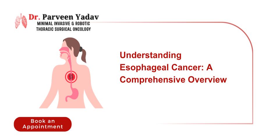 Understanding Esophageal Cancer: A Comprehensive Overview