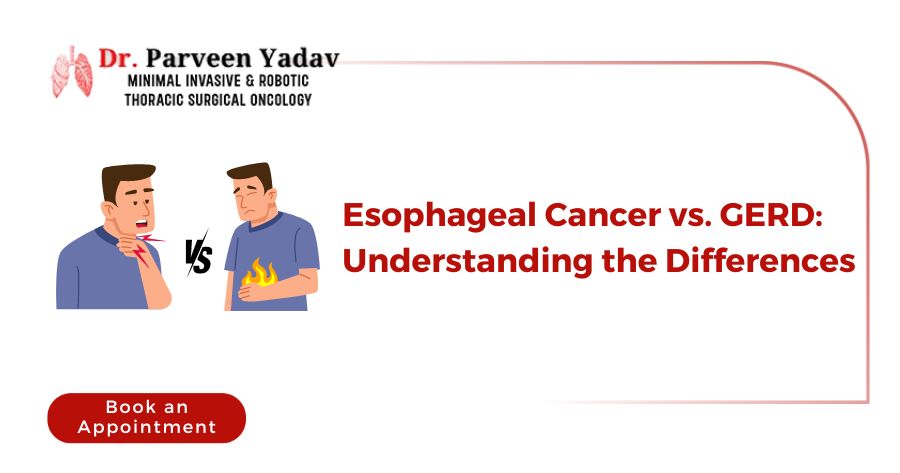 Esophageal Cancer vs. GERD: Understanding the Differences