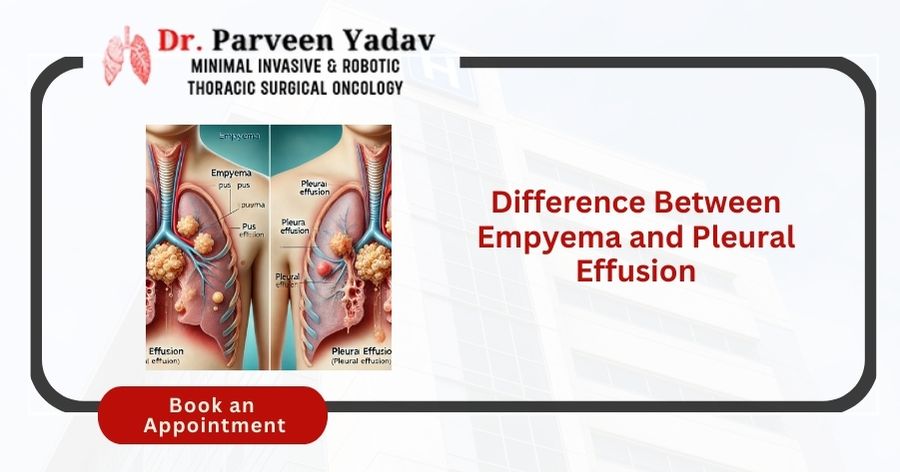 Difference Between Empyema and Pleural Effusion