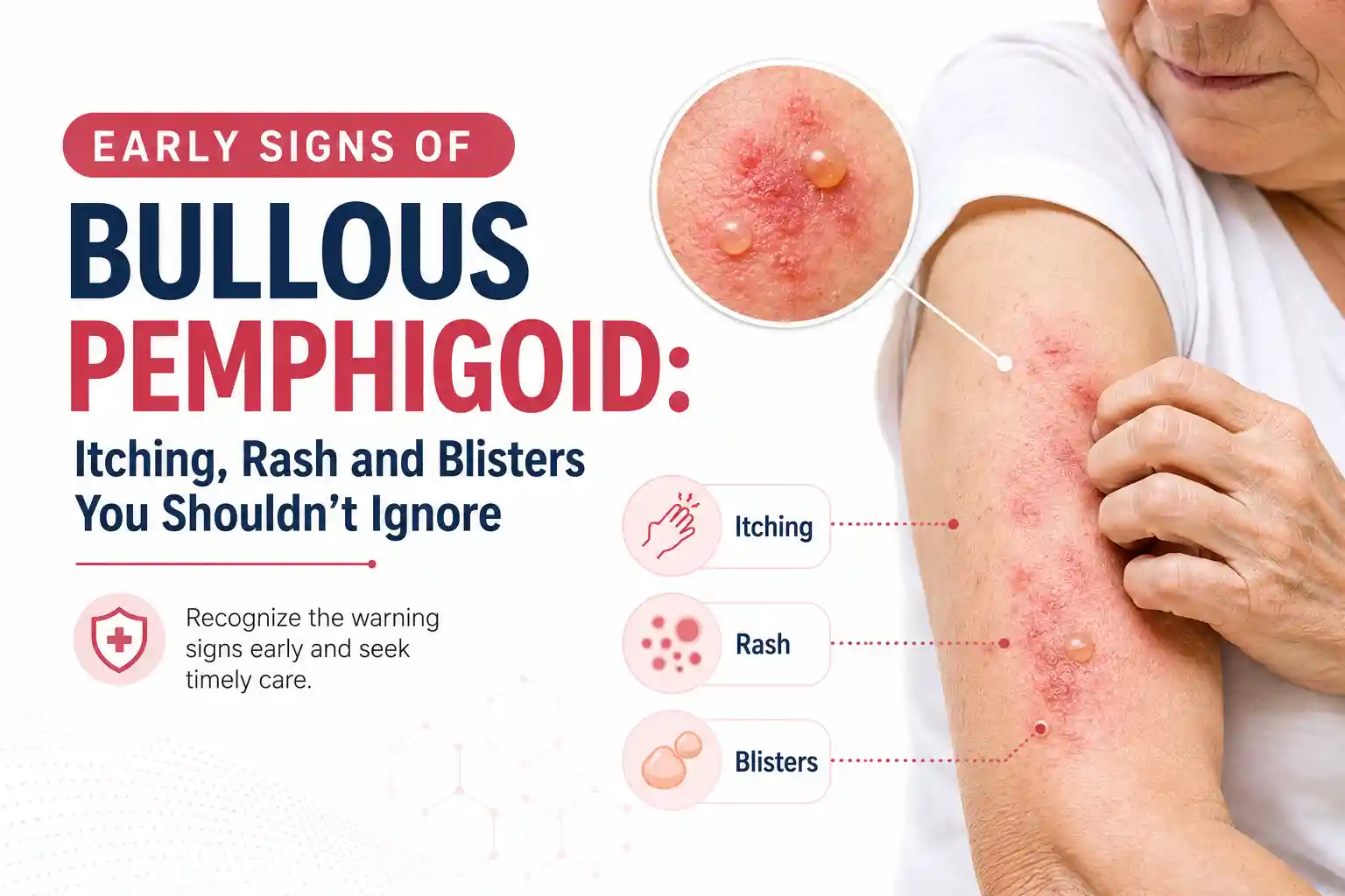 Early Signs of Bullous Pemphigoid: Itching, Rash and Blisters You Shouldn't Ignore