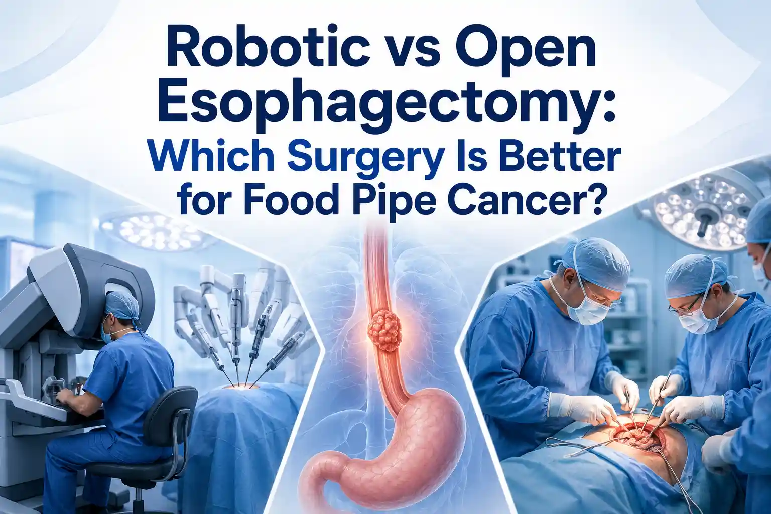 Robotic vs Open Esophagectomy: Which Surgery Is Better for Food Pipe Cancer?